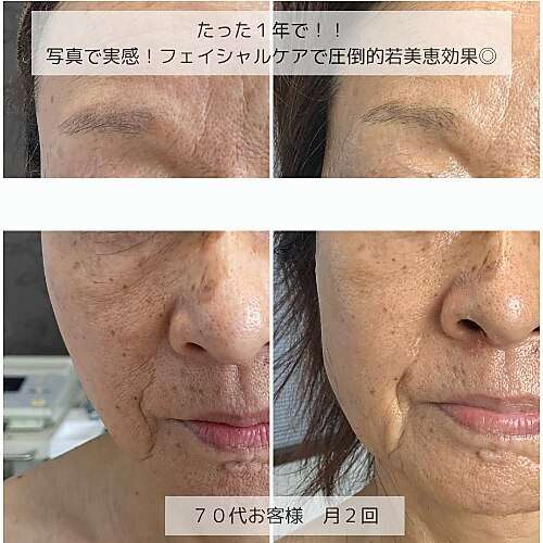 リベルハーブピーリング セット ハーブピーリング 20251008123732.jpg