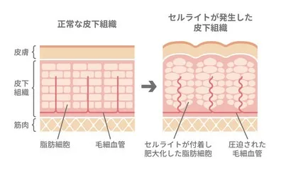 セルライトとは？女性の約9割が抱える悩みの正体とは