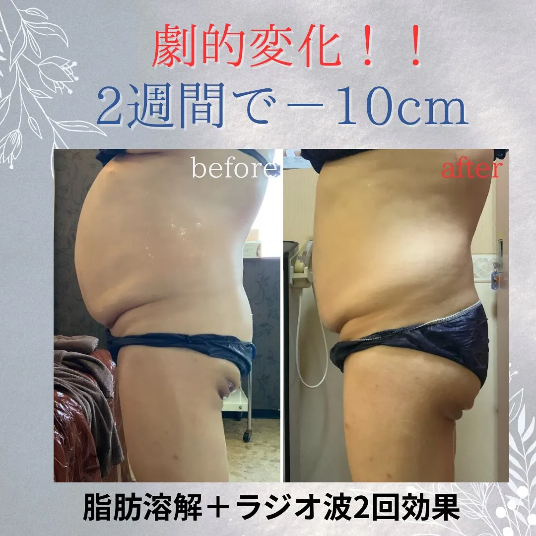 🌟【たった2週間でお腹－10cm！？】🌟