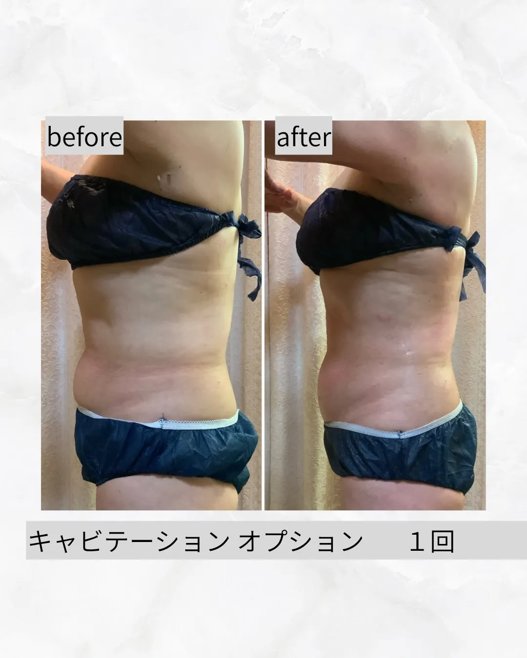 【新 キャビテーション 症例】