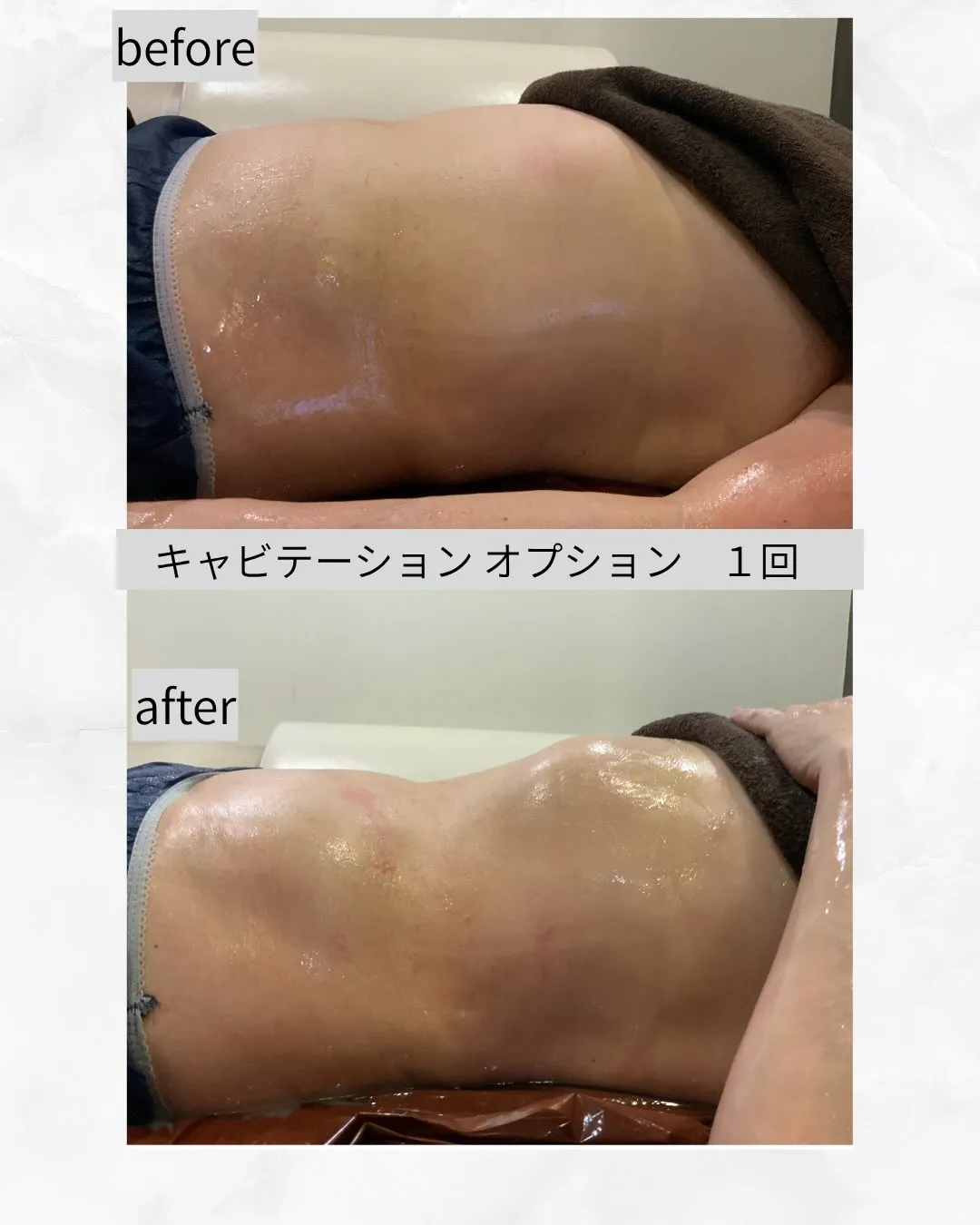 【新 キャビテーション 症例】