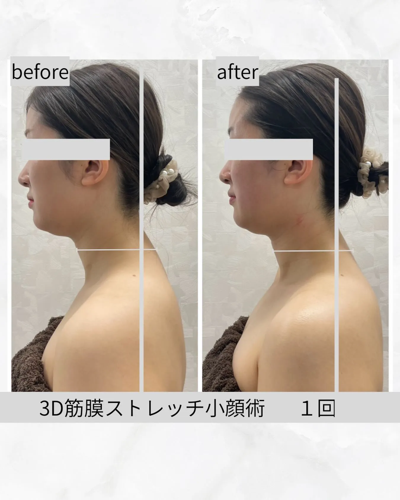 【3D筋膜ストレッチ小顔術  猫背ver】